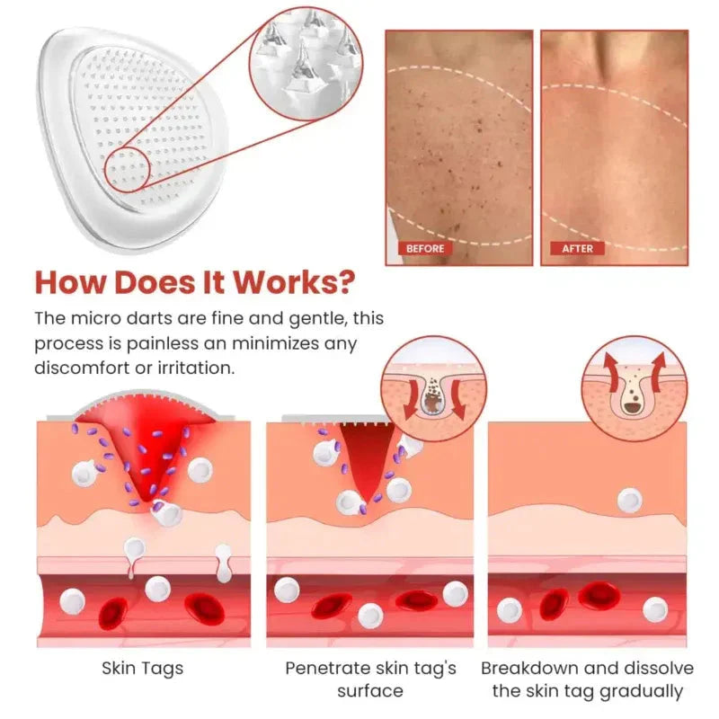 Derma Smooth Skin Tag Removal Patch -  100% Results